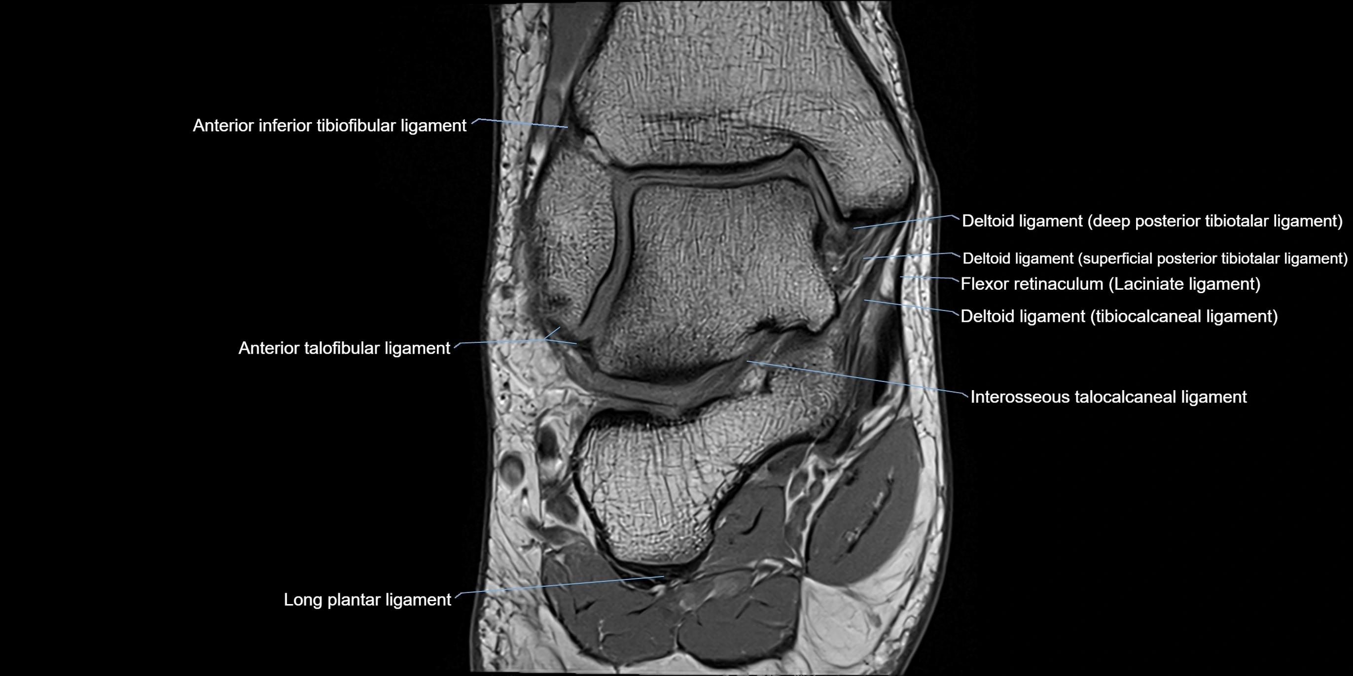 MRI Ankle coronal ligaments cross sectional anatomy 3T  radiology  image-img-00001-00011.webp